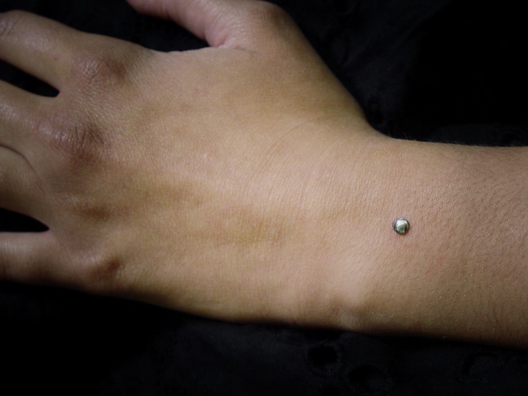 003 microdermals