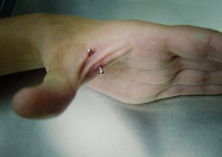 008 microdermals