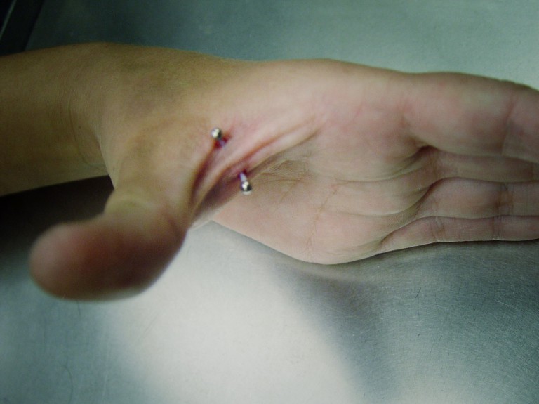 008 microdermals