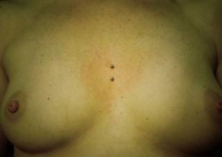009 microdermals