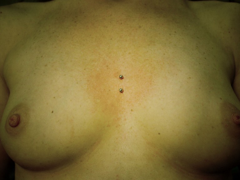 009 microdermals