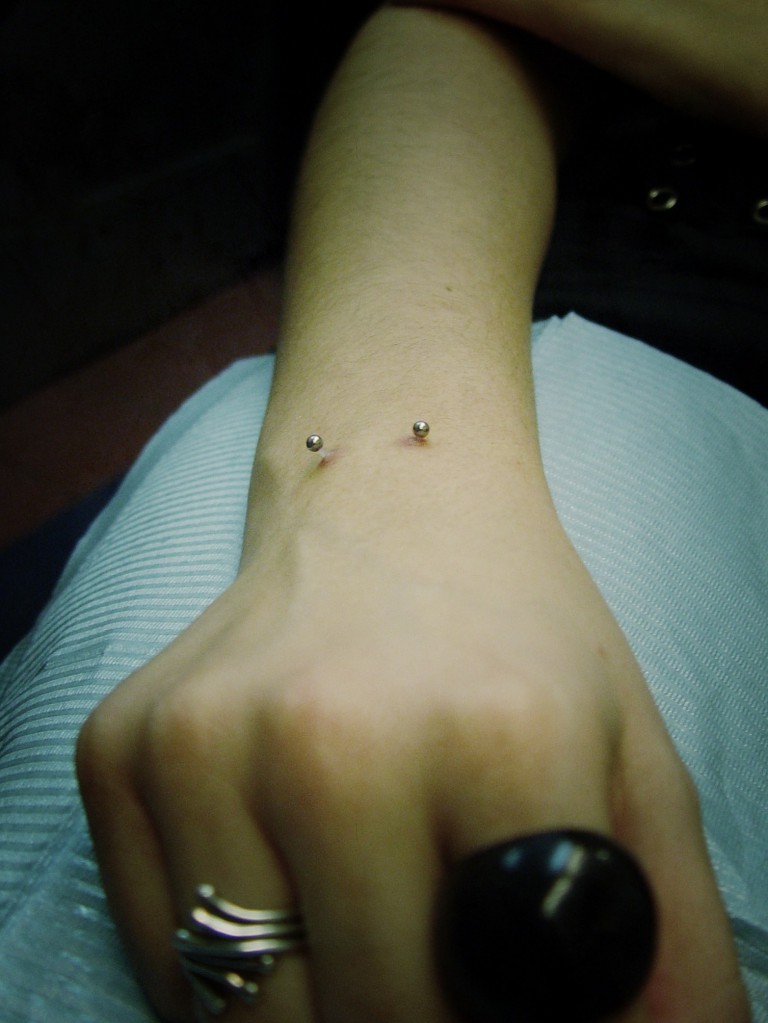 010 microdermals