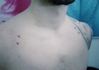 016 microdermals