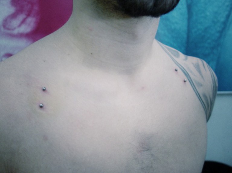 016 microdermals
