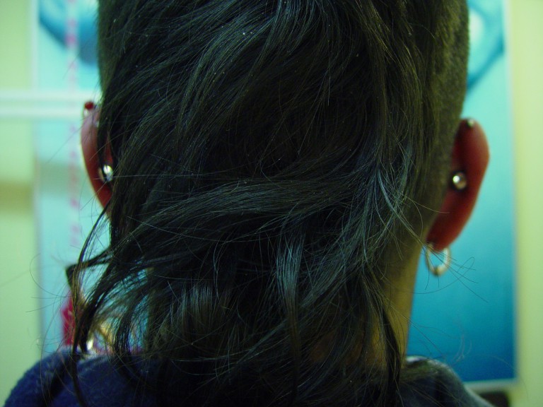 011 oreja concha -Biopsia
